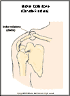 Thumbnail image of: Broken Collarbone (Fractured Clavicle):  Illustration