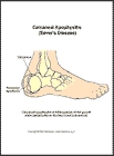 Thumbnail image of: Calcaneal Apophysitis (Sever's Disease):  Illustration