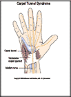 Thumbnail image of: Carpal Tunnel Syndrome: Illustration