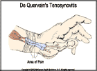 Thumbnail image of: De Quervain's Tenosynovitis:  Illustration