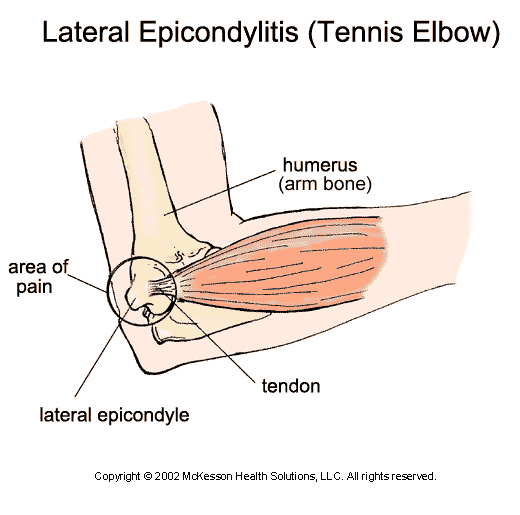 Lateral Epicondylitis (Tennis Elbow): Illustration