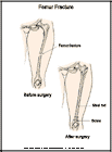 Thumbnail image of: Femur Fracture and Repair:  Illustration