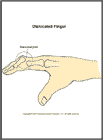 Thumbnail image of: Finger Dislocation:  Illustration