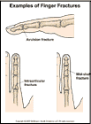 Thumbnail image of: Finger Fractures:  Illustration