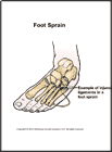 Thumbnail image of: Foot Sprain: Illustration