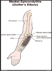 Thumbnail image of: Medial Epicondylitis (Golfer's Elbow):  Illustration