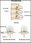 Thumbnail image of: Herniated Disk:  Illustration