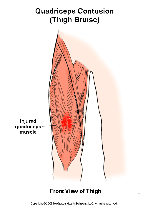 Quadriceps Contusion (Thigh Bruise):  Illustration