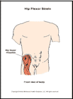 Thumbnail image of: Hip Flexor Strain:  Illustration