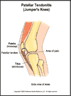 Thumbnail image of: Patellar Tendonitis (Jumper's Knee): Illustration