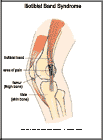Thumbnail image of: Iliotibial Band Syndrome:  Illustration
