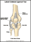 Thumbnail image of: Lateral Collateral Ligament Tear: Illustration