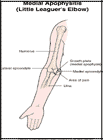 Thumbnail image of: Medial Apophysitis (Little Leaguer's Elbow):  Illustration