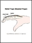 Thumbnail image of: Mallet Finger (Baseball Finger):  Illustration