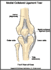 Thumbnail image of: Medial Collateral Ligament Tear: Illustration