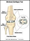 Thumbnail image of: Meniscal (Cartilage) Tear: Illustration