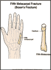 Thumbnail image of: Fifth Metacarpal Fracture:  Illustration