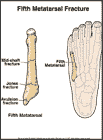 Thumbnail image of: Fifth Metatarsal Fracture:  Illustration