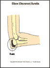 Thumbnail image of: Elbow (Olecranon) Bursitis:  Illustration