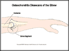 Thumbnail image of: Osteochondritis Dissecans (Bone Chips) of the Elbow: Illustration