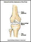 Thumbnail image of: Osteochondritis Dissecans (Bone Chips) of the Knee: Illustration