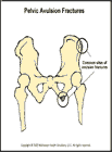 Thumbnail image of: Pelvic Avulsion Fractures:  Illustration