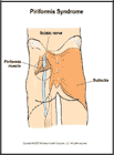 Thumbnail image of: Piriformis Syndrome:  Illustration