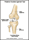 Thumbnail image of: Posterior Cruciate Ligament Tear:  Illustration