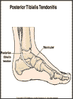 Thumbnail image of: Posterior Tibial Tendonitis:  Illustration
