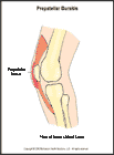 Thumbnail image of: Prepatellar (Knee) Bursitis:  Illustration