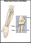 Thumbnail image of: Radial Head Fracture: Illustration