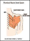 Thumbnail image of: Rhomboid Muscle Strain or Spasm:  Illustration