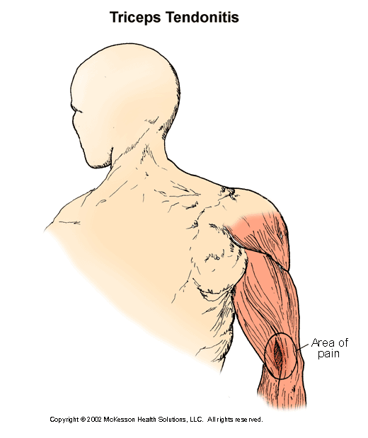 Triceps Tendonitis:  Illustration
