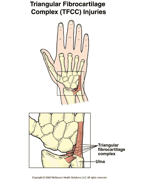 Triangular Fibrocartilage Complex:  Illustration