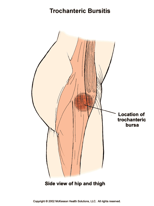 Trochanteric Bursitis:  Illustration