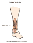 Thumbnail image of: Tendonitis de Aquiles: ilustracin