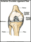 Thumbnail image of: Desgarro del ligamento anterior cruzado: ilustracin