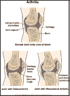 Thumbnail image of: Artritis: ilustracin