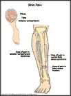Thumbnail image of: Shin Pain (Shin Splints):  Illustration