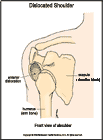 Thumbnail image of: Dislocated Shoulder:  Illustration