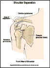 Thumbnail image of: Shoulder Separation:  Illustration