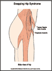 Thumbnail image of: Snapping Hip Syndrome:  Illustration