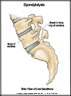 Thumbnail image of: Spondylolysis:  Illustration