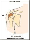 Thumbnail image of: Bursitis del hombro: ilustracin