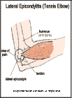 Thumbnail image of: Epicondilitis lateral: ilustracin