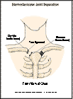 Thumbnail image of: Sternoclavicular Joint Separation:  Illustration