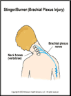Thumbnail image of: Brachial Plexus Injury (Stinger/Burner):  Illustration
