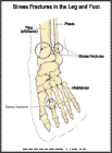 Thumbnail image of: Stress Fracture:  Illustration