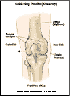 Thumbnail image of: Patellar (Kneecap) Subluxation:  Illustration