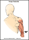 Thumbnail image of: Triceps Tendonitis:  Illustration